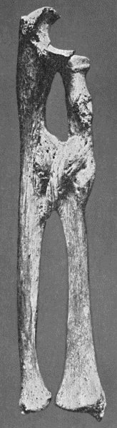 Fig. 4.—Excess of Callus after compound fracture of
Bones of Forearm.