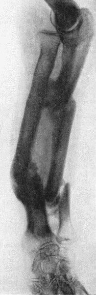 Fig. 5.—Multiple Fractures of both Bones of Forearm
showing mal-union.