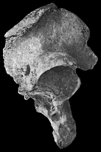 Fig. 12.—Os Innominatum showing new socket formed
after old-standing dislocation. The acetabulum is almost obliterated.