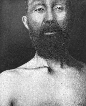 Fig. 16.—Forward Dislocation of Sternal End of Right
Clavicle. From a fall on a polished floor, in a man æt. 40.