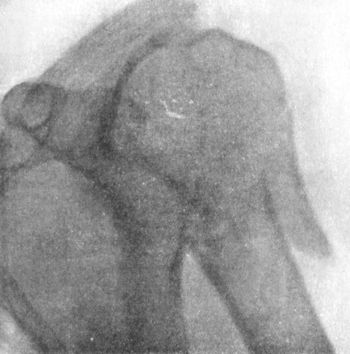 Fig. 28.—Impacted Fracture of Neck of Humerus, in man
æt. 75.