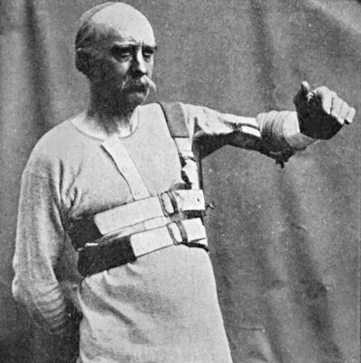 Fig. 29.—Ambulatory Abduction Splint for Fracture of
Humerus.