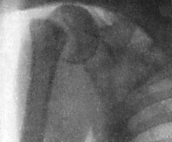 Fig. 30.—Radiogram of Separation of Upper Epiphysis of
Humerus.