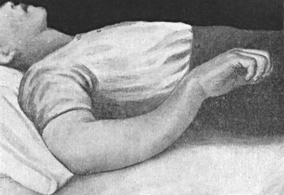 Fig. 41.—Greenstick Fracture of both Bones of the
Forearm, in a boy.