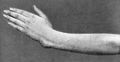 Fig. 48.—Manus Valga following separation of lower
radial epiphysis in childhood.