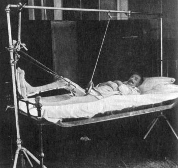 Fig. 81.—Extension applied by means of ice-tong
callipers for Fracture of Femur.