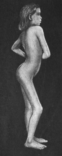 Fig. 130.—Congenital Dislocation of Left Hip in a girl
æt. 8. The patient is putting the whole weight on the dislocated
limb.