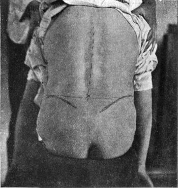 Fig. 183.—Localisation of site for introduction of
needle in Lumbar Puncture.