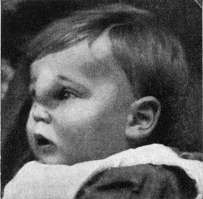 Fig. 199.—Nævus at Root of Nose, simulating
Cephalocele.