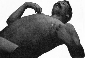 Fig. 206.—Attitude of Upper Extremities in Traumatic
Lesions of the Sixth Cervical Segment. The prominence of the abdomen
is due to gaseous distension of the bowel.