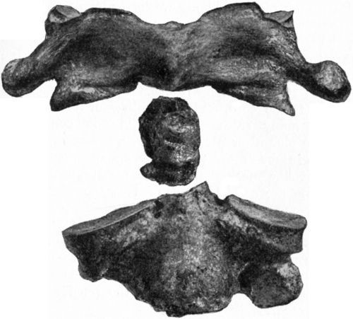 Fig. 209.—Fracture of Odontoid Process of Axis
Vertebra.
