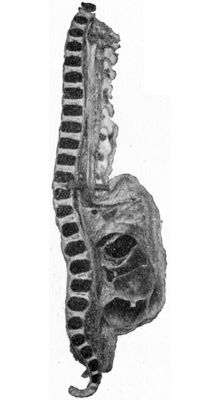 Fig. 219.—Meningo-myelocele of Thoracico-lumbar
Region.