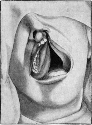 Fig. 236.—Asymmetrical Cleft Palate extending through
alveolar process on left side.