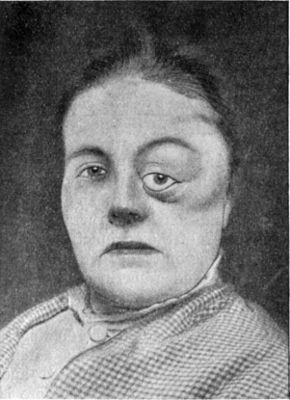 Fig. 238.—Sarcoma of Orbit, causing exophthalmos and
downward displacement of the eye, and projecting in temporal region.