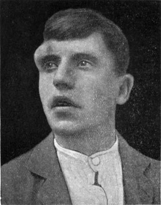 Fig. 240.—Dermoid Cyst at outer angle of orbital
margin.