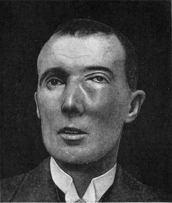 Fig. 251.—Malignant Disease of Left Maxilla, which
displaced the eyeball and caused double vision.