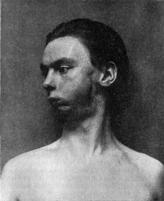 Fig. 256.—Defective development of Mandible from
fixation of jaw due to tuberculous osteomyelitis in infancy.