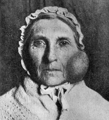 Fig. 264.—Mixed Tumour of the Parotid of over twenty
years' duration.