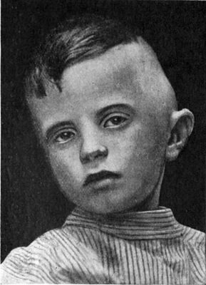 Fig. 265.—Acute Mastoid Disease, showing œdema and
projection of auricle.