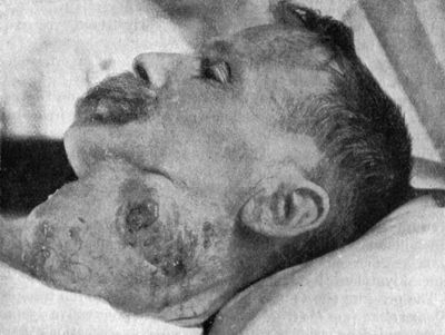 Fig. 276.—Branchial Carcinoma—subsequently removed by
operation.