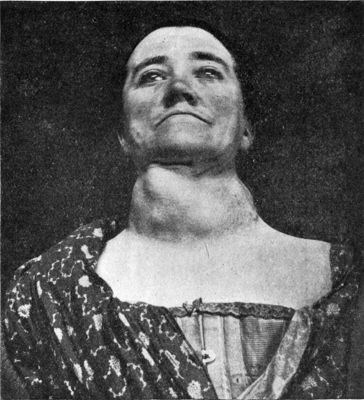 Fig. 280.—Multiple Adenomata of Thyreoid in a woman
æt. 50.