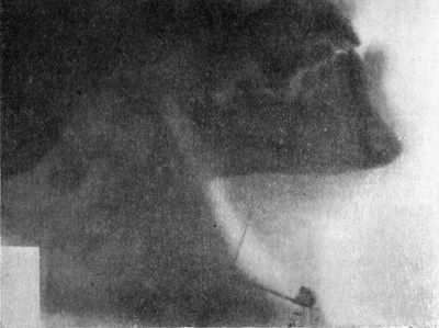 Fig. 283.—Radiogram of Safety-pin impacted in the
Gullet and perforating the Larynx.