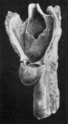 Fig. 286.—Diverticulum of the Œsophagus at its
junction with the Pharynx.