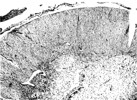 Lumbar cord in case of scurvy. Focal degeneration