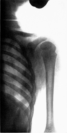 Complete restitution of epiphysis without deformity. Roentgenogram